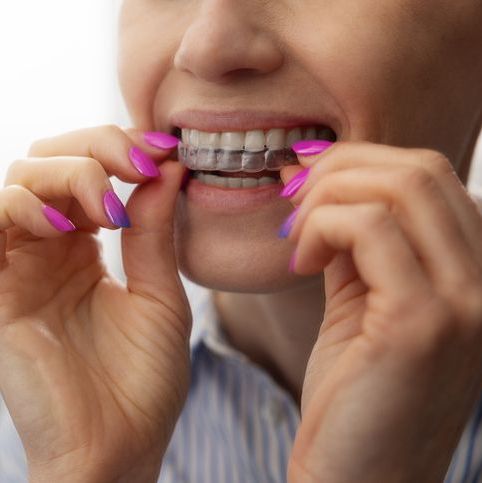 Person placing a clear aligner over their upper teeth