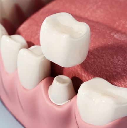 Dental crown model positioned above a prepared tooth on a dental teaching model