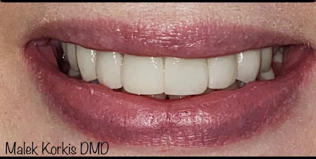 After Smile Design, case 2
