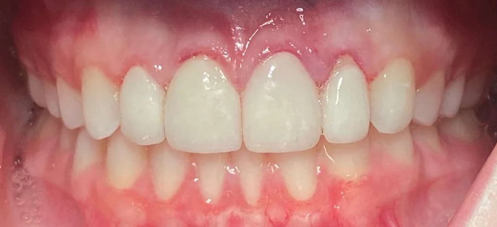 After Smile Design, case 1