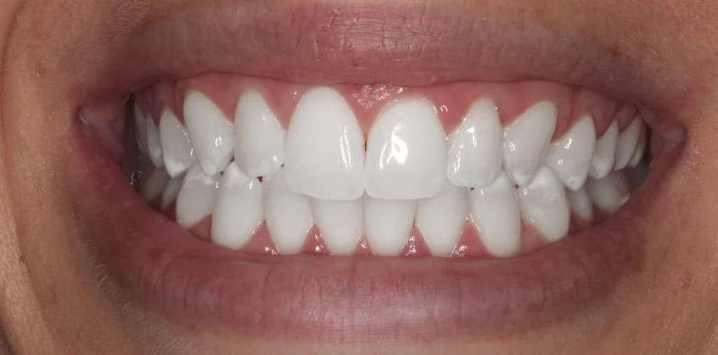 After Whitening, case 3